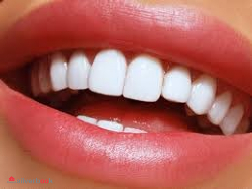 ایمپلنت دندان کره ای - لمینت و کامپوزیت دندان