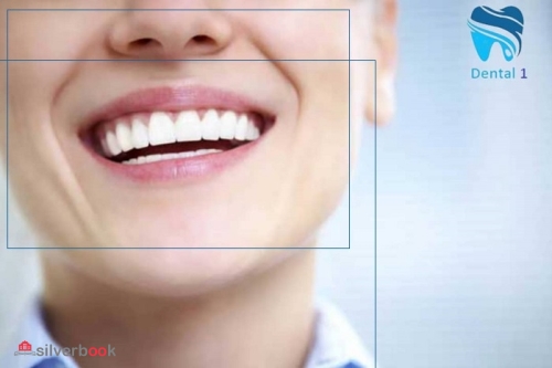 ونیر کامپوزیت دندان - دندانپزشکی -لبخند هالیوودی