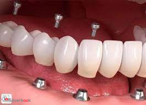 ایمپلنت دندان دیجیتال در ده دقیقه - دندانپزشکی