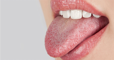 روش های درمان خشکی دهان