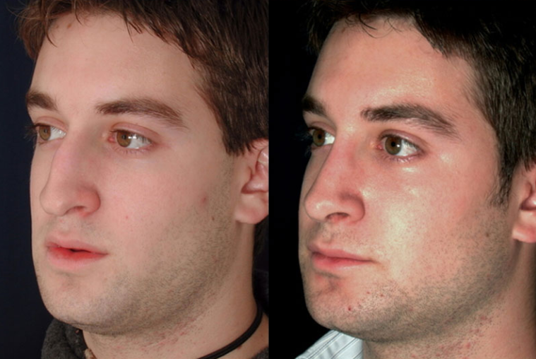 عکس قبل و بعد از عمل بینی 