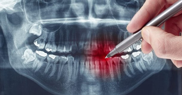 تشخیص دندان به عصب رسیده از روی عکس