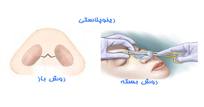 جراحی بینی به روش باز