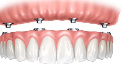عوامل موثر بر مدت ایمپلنت دندان
